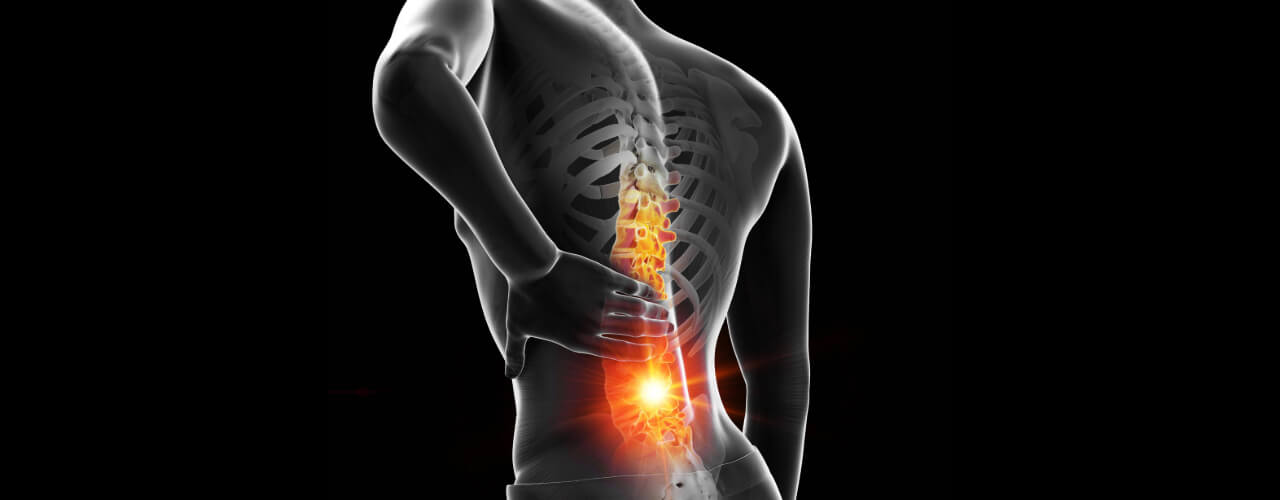 How to Manage Back Pain from a Herniated Disc