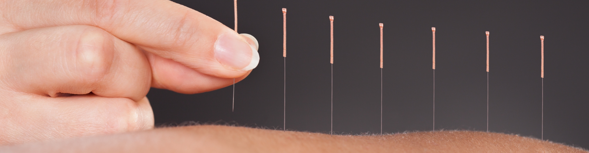 Acupuncture