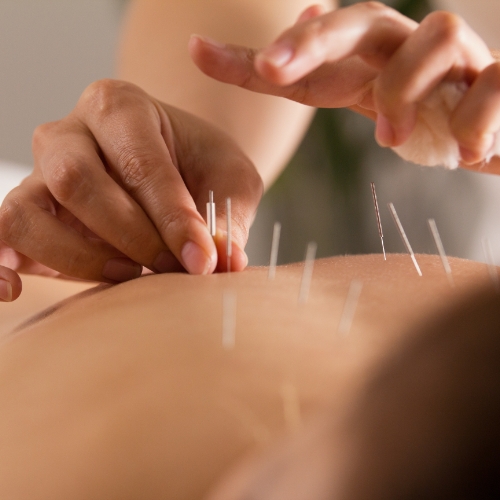 acupuncture-Excelsior-Physiotherapy-Sherwood-Park-AB