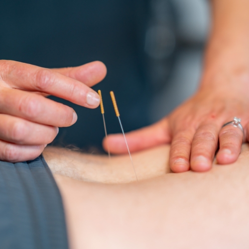 dry-needling-Excelsior-Physiotherapy-Sherwood-Park-AB
